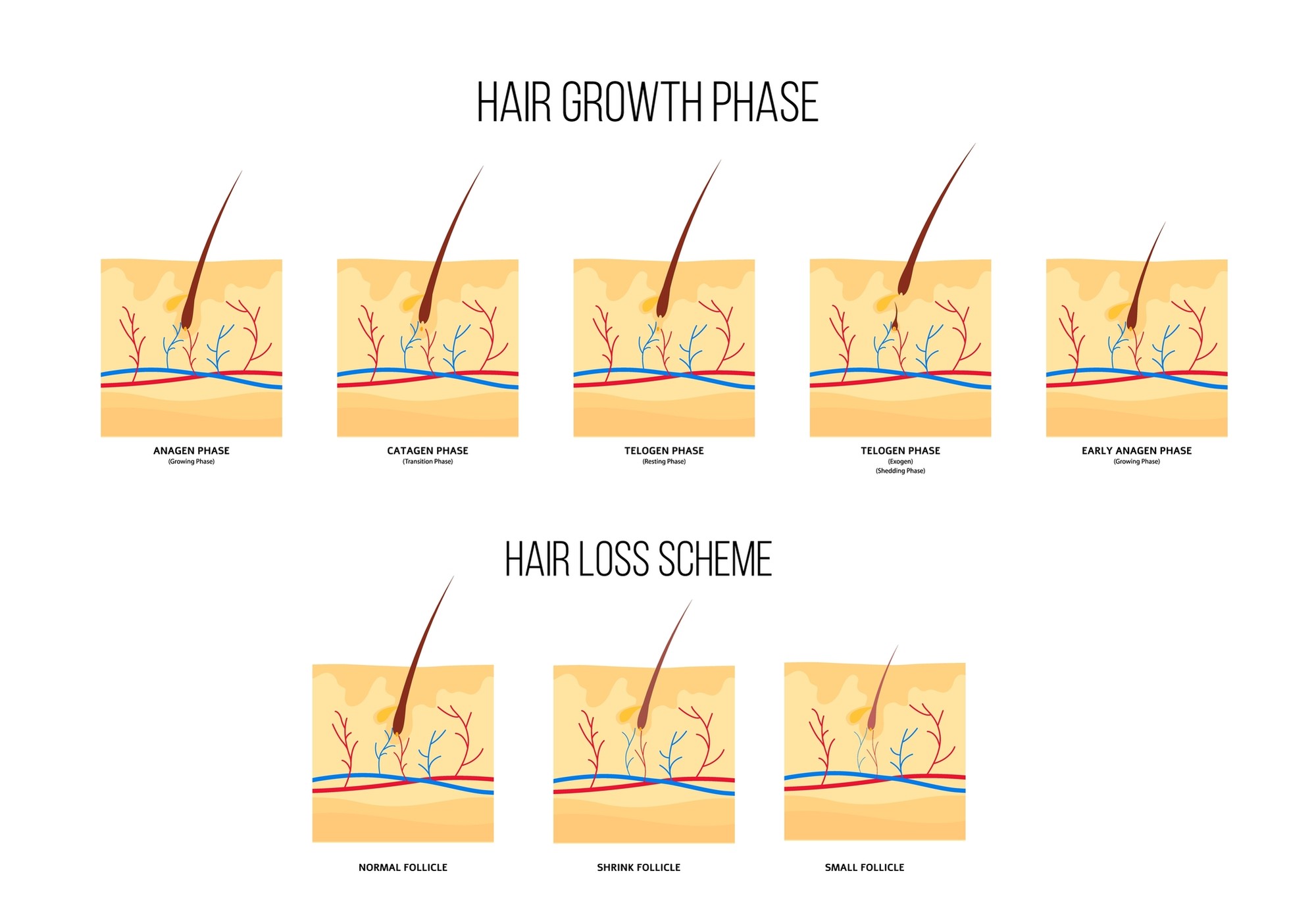 Выпадение волос в зависимости от формы алопеции