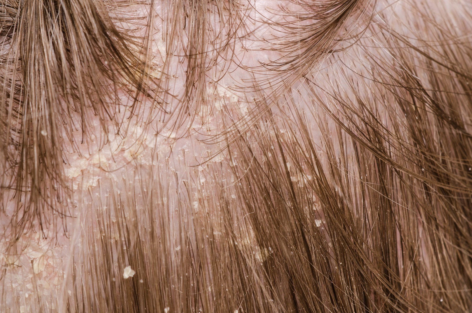 Перхоть и поредение волос при себорейной алопеции